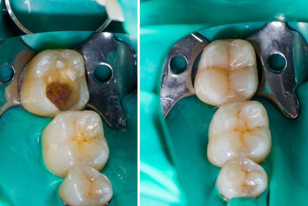 Natural looking dental filling before and after series.